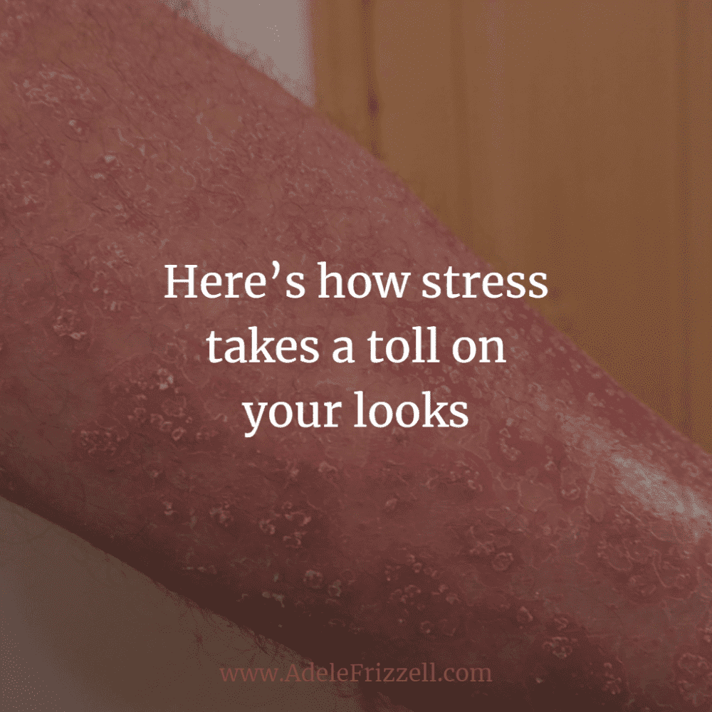Stress and Skin: How stress takes a toll on your looks